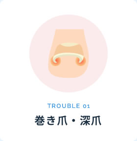巻き爪・深爪